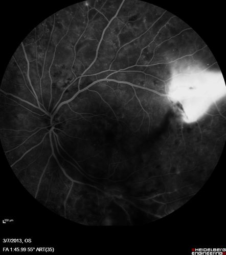 Proliferative Diabetic Retinopathy and Vitreous Hemorrhage - FA shows leakage of dye from NVE
