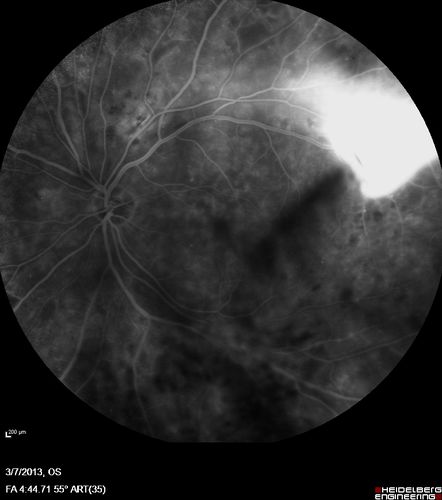 Proliferative Diabetic Retinopathy and Vitreous Hemorrhage - FA shows leakage of dye from NVE

