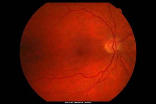 Proliferative Diabetic Retinopathy both Eyes Neovascularization of the Disc
63-year-old woman has been diabetic for twenty one years who sees new floaters in the right eye.  OD 20/40,  OS 20/40.
Keywords: PDR;proliferative diabetic retinopathy;nvd;nve