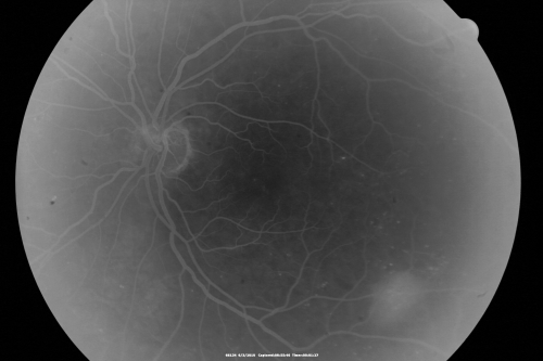 Proliferative Diabetic Retinopathy both Eyes Neovascularization of the Disc
63-year-old woman has been diabetic for twenty one years who sees new floaters in the right eye.  OD 20/40,  OS 20/40.
Keywords: PDR;proliferative diabetic retinopathy;nvd;nve