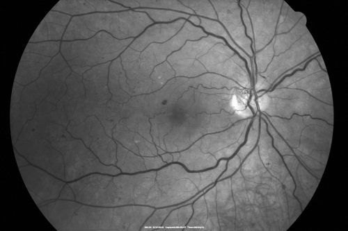 Proliferative Diabetic Retinopathy both Eyes Neovascularization of the Disc
63-year-old woman has been diabetic for twenty one years who sees new floaters in the right eye.  OD 20/40,  OS 20/40.
Keywords: PDR;proliferative diabetic retinopathy;nvd;nve