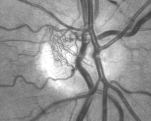 Proliferative Diabetic Retinopathy both Eyes Neovascularization of the Disc
63-year-old woman has been diabetic for twenty one years who sees new floaters in the right eye.  OD 20/40,  OS 20/40.
Keywords: PDR;proliferative diabetic retinopathy;nvd;nve