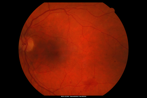 Proliferative Diabetic Retinopathy both Eyes Neovascularization of the Disc
63-year-old woman has been diabetic for twenty one years who sees new floaters in the right eye.  OD 20/40,  OS 20/40.
Keywords: PDR;proliferative diabetic retinopathy;nvd;nve
