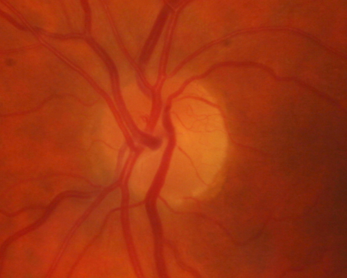 Proliferative Diabetic Retinopathy both Eyes Neovascularization of the Disc
63-year-old woman has been diabetic for twenty one years who sees new floaters in the right eye.  OD 20/40,  OS 20/40.
Keywords: PDR;proliferative diabetic retinopathy;nvd;nve