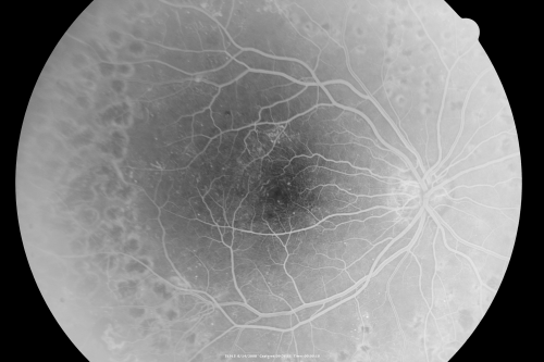 Proliferative Diabetic Retinopathy both eyes Type I Diabetic for 25 years
47-year-old woman with diabetes for 25 years and decreased vision for 3 months.  OD 20/40, OS 20/40
