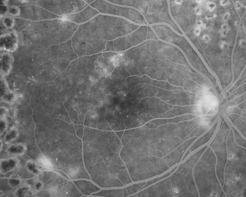 Proliferative Diabetic Retinopathy both eyes Type I Diabetic for 25 years
47-year-old woman with diabetes for 25 years and decreased vision for 3 months.  OD 20/40, OS 20/40
