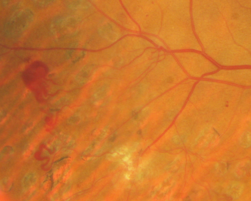 Proliferative Diabetic Retinopathy both eyes Type I Diabetic for 25 years
47-year-old woman with diabetes for 25 years and decreased vision for 3 months.  OD 20/40, OS 20/40
