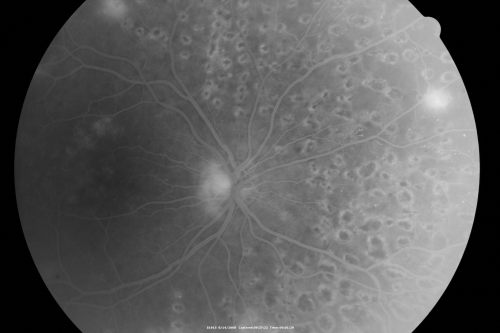 Proliferative Diabetic Retinopathy both eyes Type I Diabetic for 25 years
47-year-old woman with diabetes for 25 years and decreased vision for 3 months.  OD 20/40, OS 20/40
