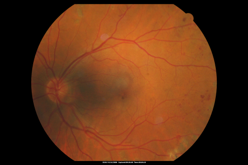 Proliferative Diabetic Retinopathy both eyes Type I Diabetic for 25 years
47-year-old woman with diabetes for 25 years and decreased vision for 3 months.  OD 20/40, OS 20/40
