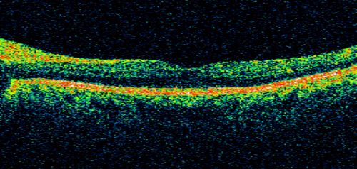 Proliferative Diabetic Retinopathy both eyes Type I Diabetic for 25 years
47-year-old woman with diabetes for 25 years and decreased vision for 3 months.  OD 20/40, OS 20/40

