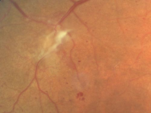 Proliferative Diabetic Retinopathy and Mild Vitreous Hemorrhage
58-year-old woman has diabetic retinopathy in both eyes with neovascularization of the optic nerve, worse in the right eye than the left eye.  Vision OD is 20/25, OS is 20/20
