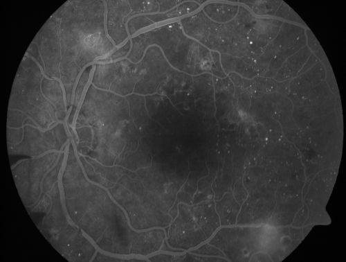 Proliferative Diabetic Retinopathy and Mild Vitreous Hemorrhage
58-year-old woman has diabetic retinopathy in both eyes with neovascularization of the optic nerve, worse in the right eye than the left eye.  Vision OD is 20/25, OS is 20/20
