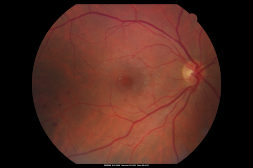 Diabetic Vitreous Hemorrhage Left Eye
35-year-old man diabetic for the last 25 years.  His hemoglobin A1C has been running between 10 and 11.  He was doing fine and then when he woke up from sleeping last night he noticed sudden vision loss in his left eye OD 20/30, OS 20/200.
