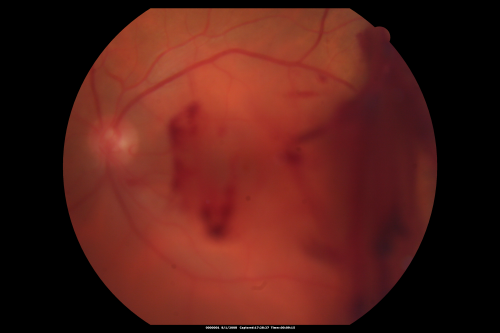 Diabetic Vitreous Hemorrhage Left Eye
35-year-old man diabetic for the last 25 years.  His hemoglobin A1C has been running between 10 and 11.  He was doing fine and then when he woke up from sleeping last night he noticed sudden vision loss in his left eye OD 20/30, OS 20/200.
