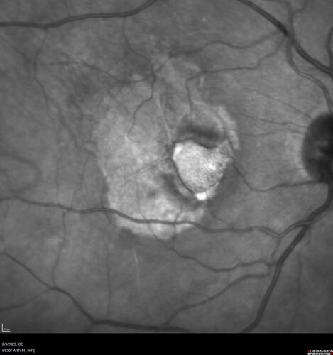 RPE tear following single treatment of vabysmo in the left eye
80 year old patient with HemiCRVO and wet AMD in the left eye.  The right eye has recent vision loss from 20/40 - 20/100.  She has a high PED and wet AMD.  She was given one treatment of half-dose vabysmo and presented next visit with a PED tear and vision of 4/200.
