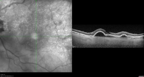 RPE tear following single treatment of vabysmo in the left eye
80 year old patient with HemiCRVO and wet AMD in the left eye.  The right eye has recent vision loss from 20/40 - 20/100.  She has a high PED and wet AMD.  She was given one treatment of half-dose vabysmo and presented next visit with a PED tear and vision of 4/200.

