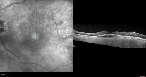 RPE tear following single treatment of vabysmo in the left eye
80 year old patient with HemiCRVO and wet AMD in the left eye.  The right eye has recent vision loss from 20/40 - 20/100.  She has a high PED and wet AMD.  She was given one treatment of half-dose vabysmo and presented next visit with a PED tear and vision of 4/200.
