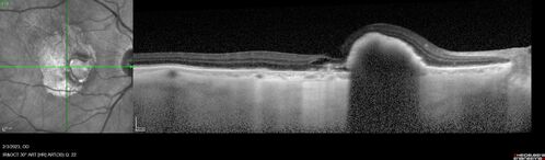 RPE tear following single treatment of vabysmo in the left eye
80 year old patient with HemiCRVO and wet AMD in the left eye.  The right eye has recent vision loss from 20/40 - 20/100.  She has a high PED and wet AMD.  She was given one treatment of half-dose vabysmo and presented next visit with a PED tear and vision of 4/200.
