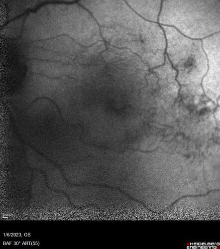 RPE tear following single treatment of vabysmo in the left eye
80 year old patient with HemiCRVO and wet AMD in the left eye.  The right eye has recent vision loss from 20/40 - 20/100.  She has a high PED and wet AMD.  She was given one treatment of half-dose vabysmo and presented next visit with a PED tear and vision of 4/200.
