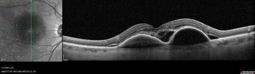 RPE tear following single treatment of vabysmo in the left eye
80 year old patient with HemiCRVO and wet AMD in the left eye.  The right eye has recent vision loss from 20/40 - 20/100.  She has a high PED and wet AMD.  She was given one treatment of half-dose vabysmo and presented next visit with a PED tear and vision of 4/200.

