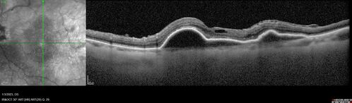 RPE tear following single treatment of vabysmo in the left eye
80 year old patient with HemiCRVO and wet AMD in the left eye.  The right eye has recent vision loss from 20/40 - 20/100.  She has a high PED and wet AMD.  She was given one treatment of half-dose vabysmo and presented next visit with a PED tear and vision of 4/200.
