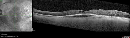 RPE tear following single treatment of vabysmo in the left eye
80 year old patient with HemiCRVO and wet AMD in the left eye.  The right eye has recent vision loss from 20/40 - 20/100.  She has a high PED and wet AMD.  She was given one treatment of half-dose vabysmo and presented next visit with a PED tear and vision of 4/200.
