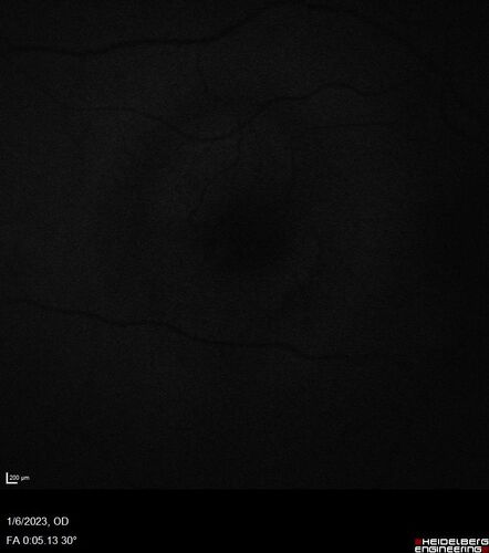 RPE tear following single treatment of vabysmo in the left eye
80 year old patient with HemiCRVO and wet AMD in the left eye.  The right eye has recent vision loss from 20/40 - 20/100.  She has a high PED and wet AMD.  She was given one treatment of half-dose vabysmo and presented next visit with a PED tear and vision of 4/200.
