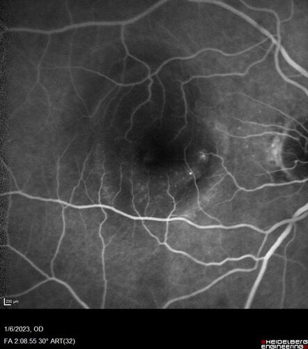 RPE tear following single treatment of vabysmo in the left eye
80 year old patient with HemiCRVO and wet AMD in the left eye.  The right eye has recent vision loss from 20/40 - 20/100.  She has a high PED and wet AMD.  She was given one treatment of half-dose vabysmo and presented next visit with a PED tear and vision of 4/200.

