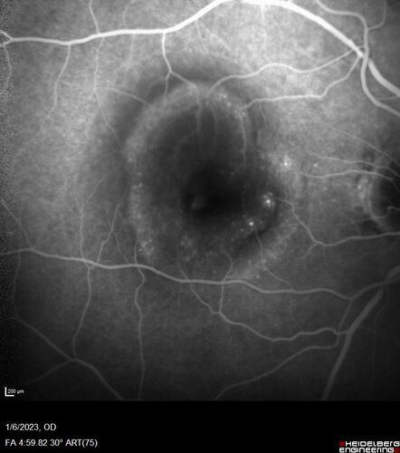 RPE tear following single treatment of vabysmo in the left eye
80 year old patient with HemiCRVO and wet AMD in the left eye.  The right eye has recent vision loss from 20/40 - 20/100.  She has a high PED and wet AMD.  She was given one treatment of half-dose vabysmo and presented next visit with a PED tear and vision of 4/200.

