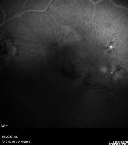 RPE tear following single treatment of vabysmo in the left eye
80 year old patient with HemiCRVO and wet AMD in the left eye.  The right eye has recent vision loss from 20/40 - 20/100.  She has a high PED and wet AMD.  She was given one treatment of half-dose vabysmo and presented next visit with a PED tear and vision of 4/200.
