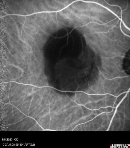 RPE tear following single treatment of vabysmo in the left eye
80 year old patient with HemiCRVO and wet AMD in the left eye.  The right eye has recent vision loss from 20/40 - 20/100.  She has a high PED and wet AMD.  She was given one treatment of half-dose vabysmo and presented next visit with a PED tear and vision of 4/200.
