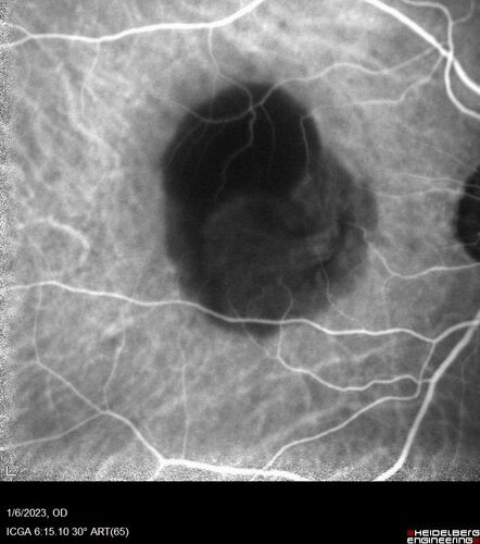 RPE tear following single treatment of vabysmo in the left eye
80 year old patient with HemiCRVO and wet AMD in the left eye.  The right eye has recent vision loss from 20/40 - 20/100.  She has a high PED and wet AMD.  She was given one treatment of half-dose vabysmo and presented next visit with a PED tear and vision of 4/200.
