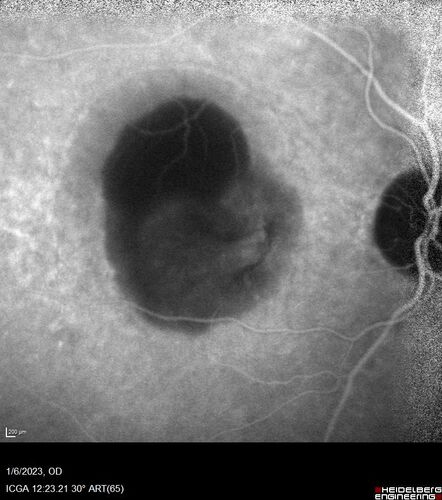 RPE tear following single treatment of vabysmo in the left eye
80 year old patient with HemiCRVO and wet AMD in the left eye.  The right eye has recent vision loss from 20/40 - 20/100.  She has a high PED and wet AMD.  She was given one treatment of half-dose vabysmo and presented next visit with a PED tear and vision of 4/200.

