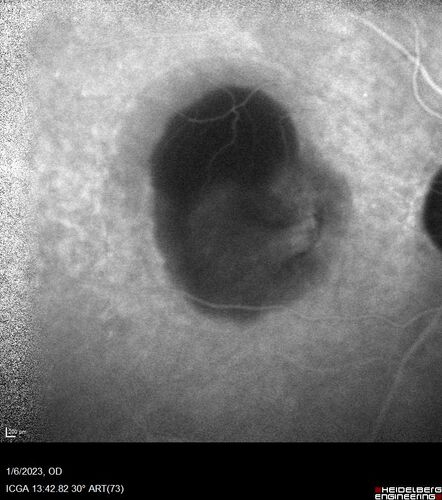 RPE tear following single treatment of vabysmo in the left eye
80 year old patient with HemiCRVO and wet AMD in the left eye.  The right eye has recent vision loss from 20/40 - 20/100.  She has a high PED and wet AMD.  She was given one treatment of half-dose vabysmo and presented next visit with a PED tear and vision of 4/200.
