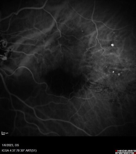 RPE tear following single treatment of vabysmo in the left eye
80 year old patient with HemiCRVO and wet AMD in the left eye.  The right eye has recent vision loss from 20/40 - 20/100.  She has a high PED and wet AMD.  She was given one treatment of half-dose vabysmo and presented next visit with a PED tear and vision of 4/200.
