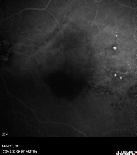 RPE tear following single treatment of vabysmo in the left eye
80 year old patient with HemiCRVO and wet AMD in the left eye.  The right eye has recent vision loss from 20/40 - 20/100.  She has a high PED and wet AMD.  She was given one treatment of half-dose vabysmo and presented next visit with a PED tear and vision of 4/200.
