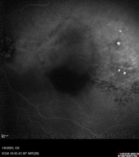 RPE tear following single treatment of vabysmo in the left eye
80 year old patient with HemiCRVO and wet AMD in the left eye.  The right eye has recent vision loss from 20/40 - 20/100.  She has a high PED and wet AMD.  She was given one treatment of half-dose vabysmo and presented next visit with a PED tear and vision of 4/200.
