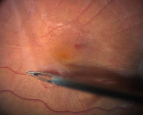 Vitrectomy with membrane peel
Intraoperative images showing the peeling of an epiretinal membrane - macular pucker - with a 25 gauge forcepts.
