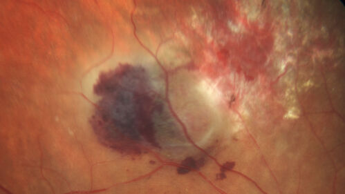 Peripheral exudative hemorrhagic chorioretinopathy - PECHR - Subfoveal fluid
85 year old female with 
Fluctuating   vision in the right eye.  
VA 20/200 OD, 20/32 OS
