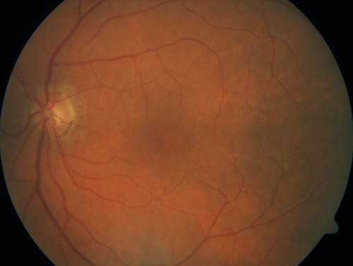 Peripheral exudative hemorrhagic chorioretinopathy - PECHR - Subfoveal fluid
85 year old female with 
Fluctuating   vision in the right eye.  
VA 20/200 OD, 20/32 OS
