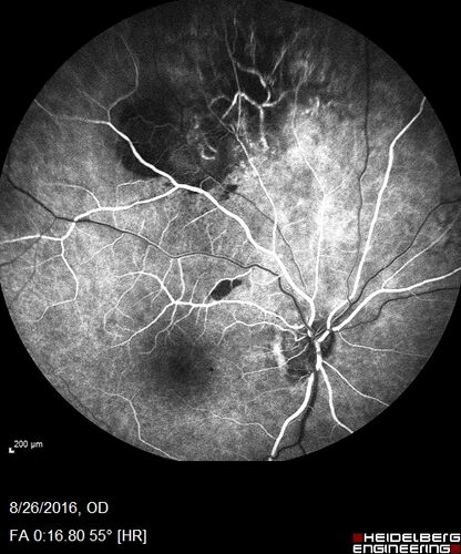 Peripheral exudative hemorrhagic chorioretinopathy - PECHR - Subfoveal fluid
85 year old female with 
Fluctuating   vision in the right eye.  
VA 20/200 OD, 20/32 OS
