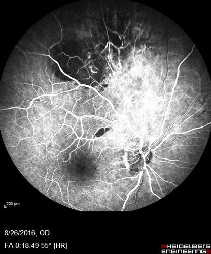 Peripheral exudative hemorrhagic chorioretinopathy - PECHR - Subfoveal fluid
85 year old female with 
Fluctuating   vision in the right eye.  
VA 20/200 OD, 20/32 OS
