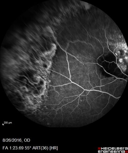 Peripheral exudative hemorrhagic chorioretinopathy - PECHR - Subfoveal fluid
85 year old female with 
Fluctuating   vision in the right eye.  
VA 20/200 OD, 20/32 OS
