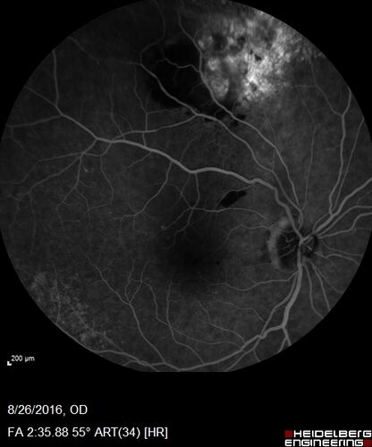 Peripheral exudative hemorrhagic chorioretinopathy - PECHR - Subfoveal fluid
85 year old female with 
Fluctuating   vision in the right eye.  
VA 20/200 OD, 20/32 OS
