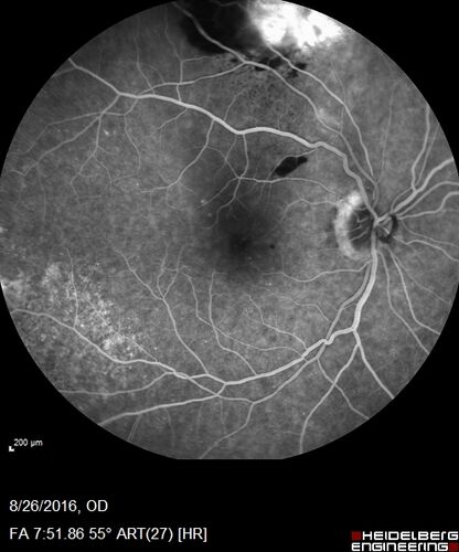 Peripheral exudative hemorrhagic chorioretinopathy - PECHR - Subfoveal fluid
85 year old female with 
Fluctuating   vision in the right eye.  
VA 20/200 OD, 20/32 OS
