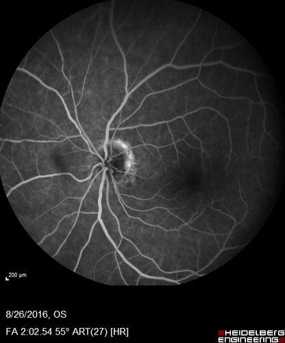Peripheral exudative hemorrhagic chorioretinopathy - PECHR - Subfoveal fluid
85 year old female with 
Fluctuating   vision in the right eye.  
VA 20/200 OD, 20/32 OS
