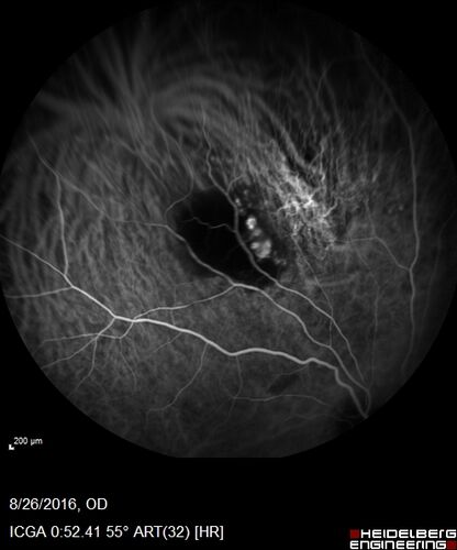 Peripheral exudative hemorrhagic chorioretinopathy - PECHR - Subfoveal fluid
85 year old female with 
Fluctuating   vision in the right eye.  
VA 20/200 OD, 20/32 OS
