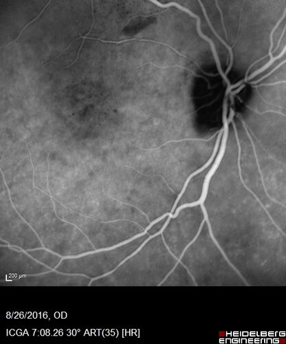 Peripheral exudative hemorrhagic chorioretinopathy - PECHR - Subfoveal fluid
85 year old female with 
Fluctuating   vision in the right eye.  
VA 20/200 OD, 20/32 OS
