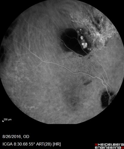 Peripheral exudative hemorrhagic chorioretinopathy - PECHR - Subfoveal fluid
85 year old female with 
Fluctuating   vision in the right eye.  
VA 20/200 OD, 20/32 OS
