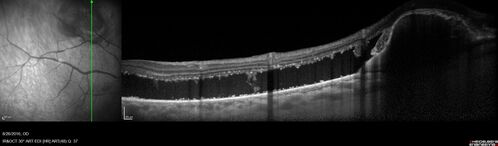 Peripheral exudative hemorrhagic chorioretinopathy - PECHR - Subfoveal fluid
85 year old female with 
Fluctuating   vision in the right eye.  
VA 20/200 OD, 20/32 OS

